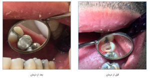 ترمیم آمالگام